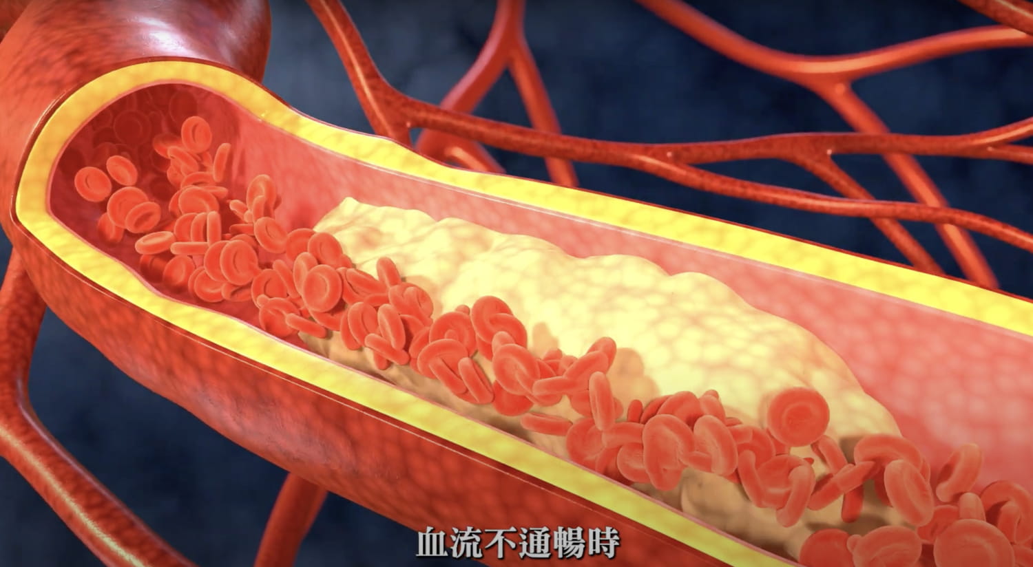 EECP是一種非侵入性心血管療法，透過同步加壓技術幫助血液回流，改善心絞痛與血管阻塞