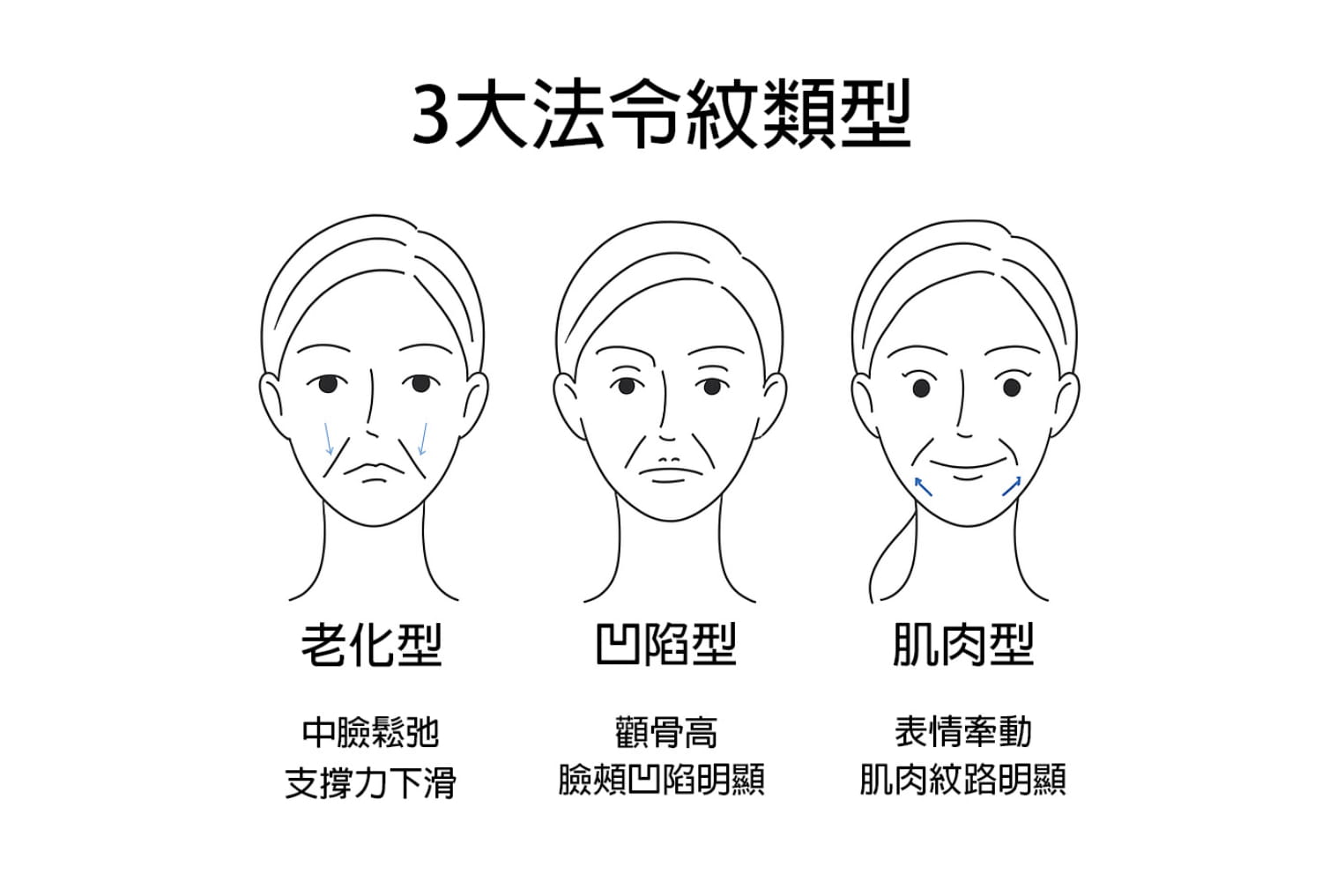 三大法令紋類型