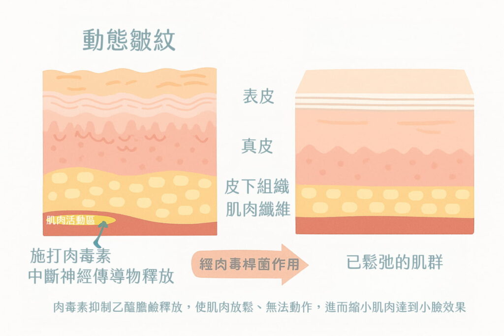 肉毒桿菌作用原理