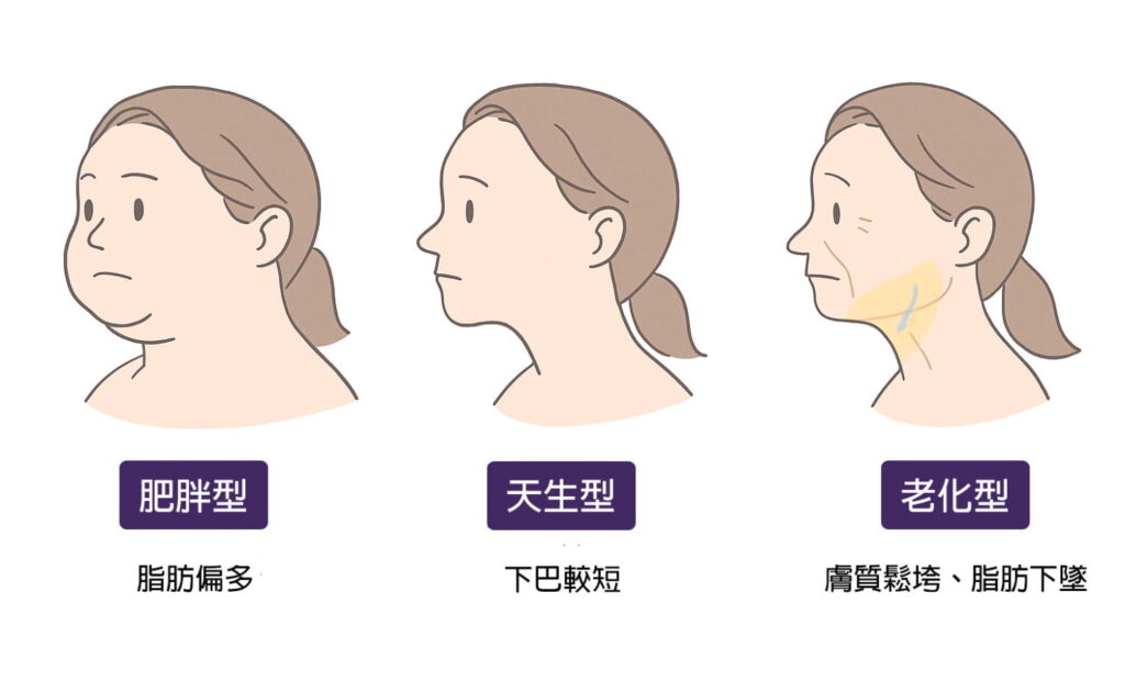 雙下巴類型