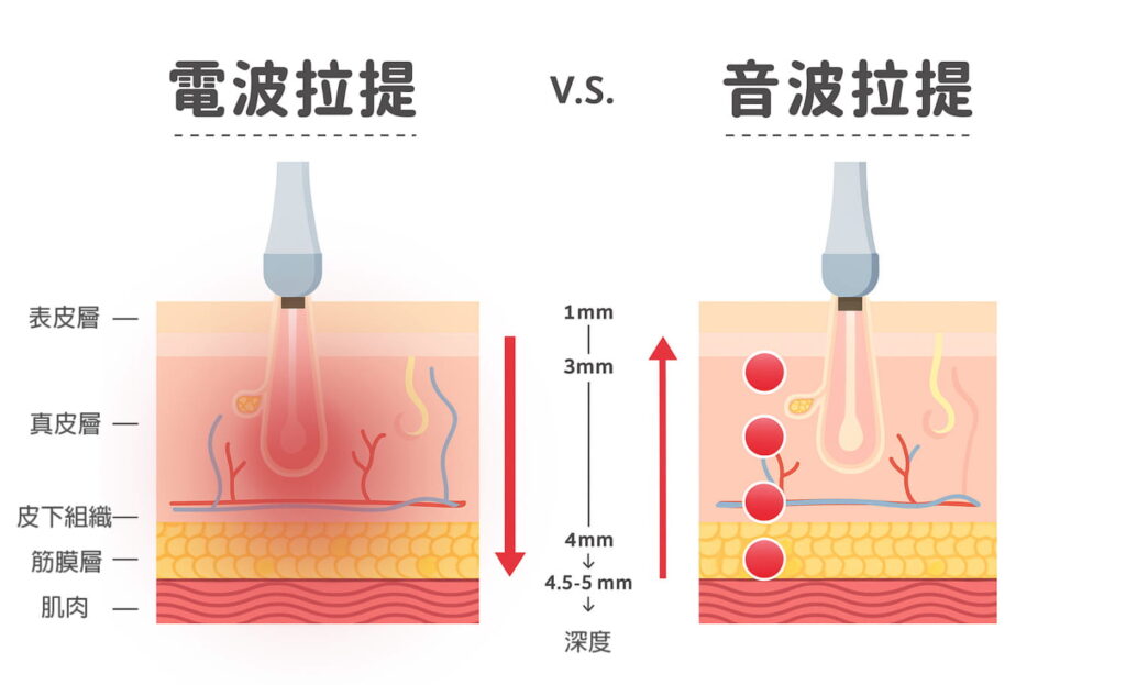 電波拉提vs音波拉提