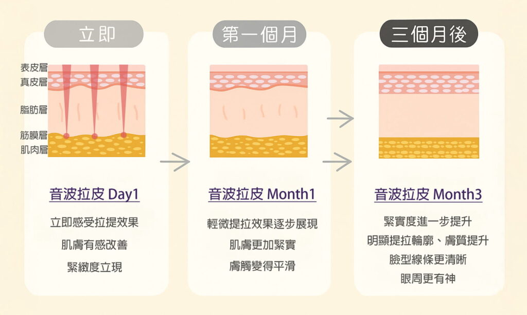 音波拉提效果時程