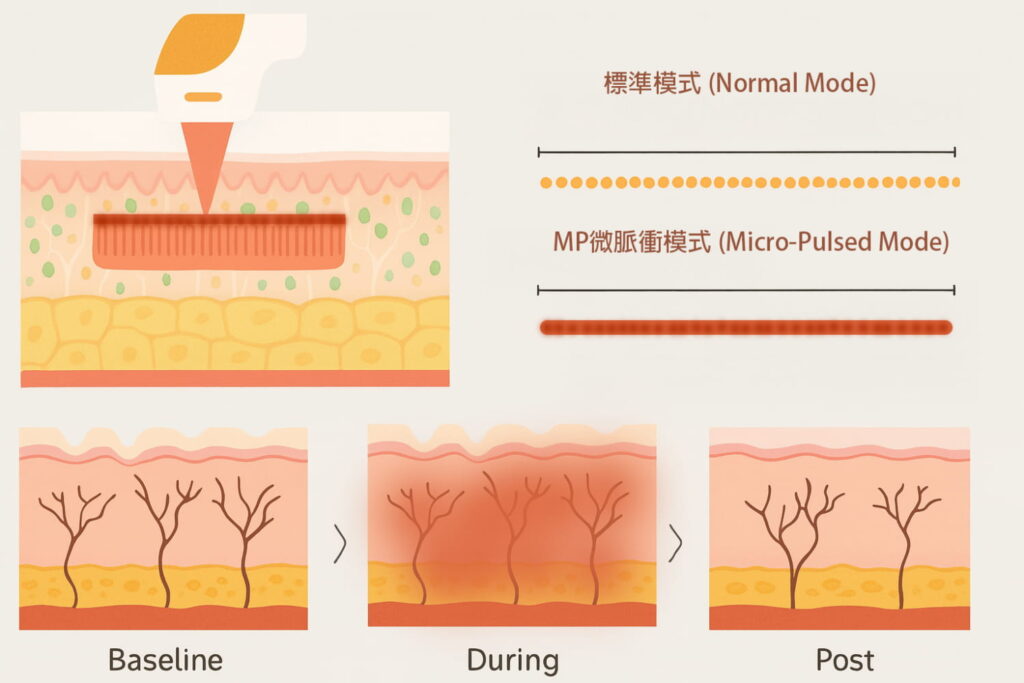 海芙音波媚必提升級特點：微脈衝模式