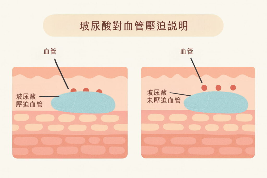 玻尿酸對血管壓迫說明